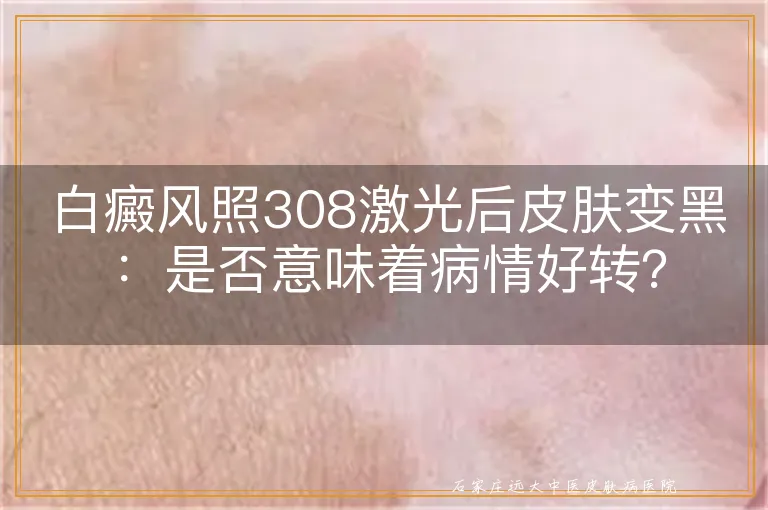 白癜风照308激光后皮肤变黑：是否意味着病情好转？