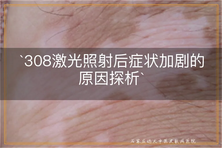 `308激光照射后症状加剧的原因探析`