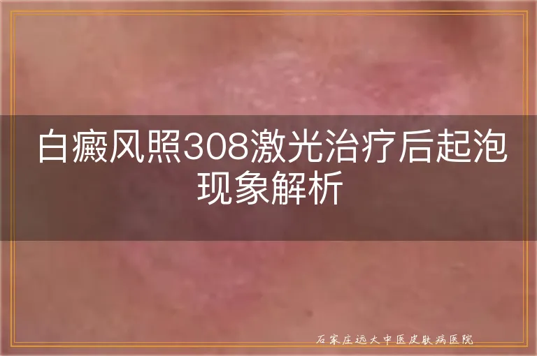 白癜风照308激光治疗后起泡现象解析