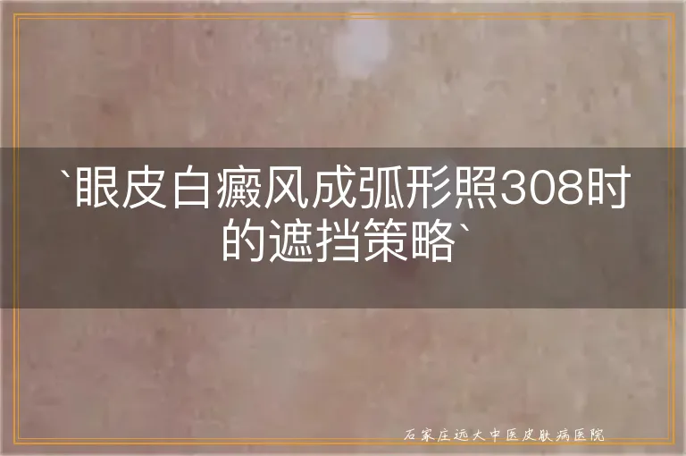 `眼皮白癜风成弧形照308时的遮挡策略`