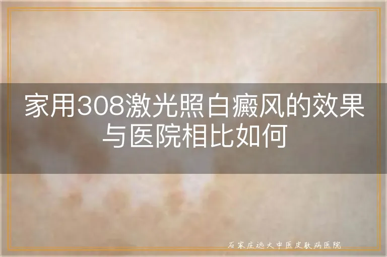 家用308激光照白癜风的效果与医院相比如何