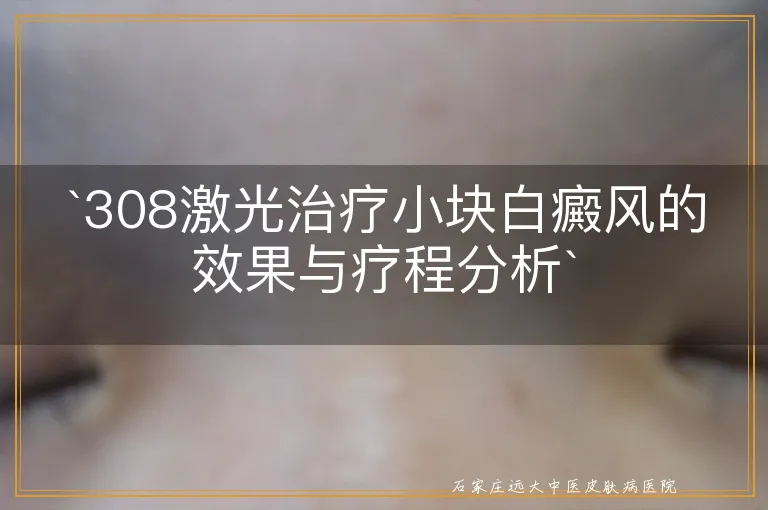 `308激光治疗小块白癜风的效果与疗程分析`