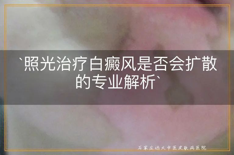 `照光治疗白癜风是否会扩散的专业解析`