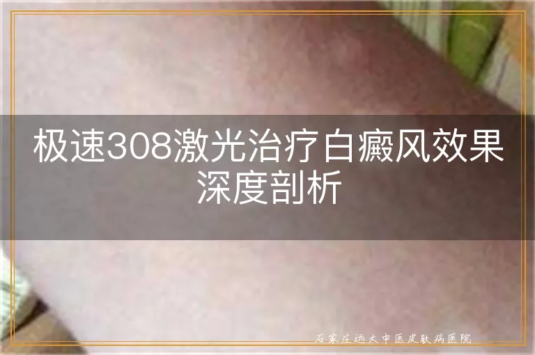 极速308激光治疗白癜风效果深度剖析