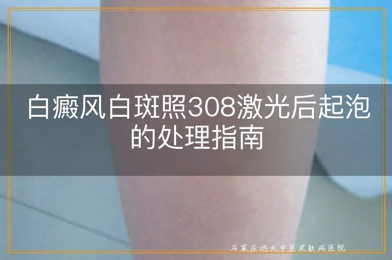 白癜风白斑照308激光后起泡的处理指南