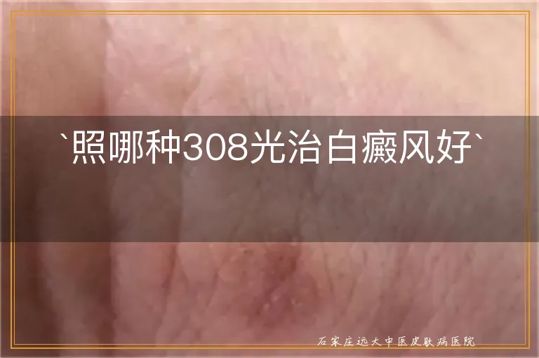 `照哪种308光治白癜风好`