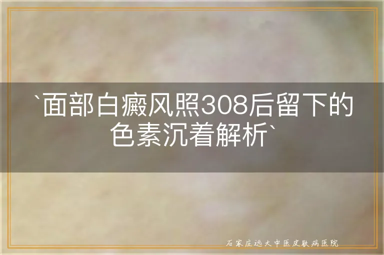 `面部白癜风照308后留下的色素沉着解析`