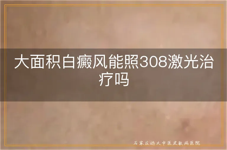 大面积白癜风能照308激光治疗吗