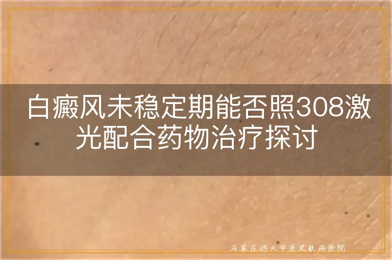 白癜风未稳定期能否照308激光配合药物治疗探讨