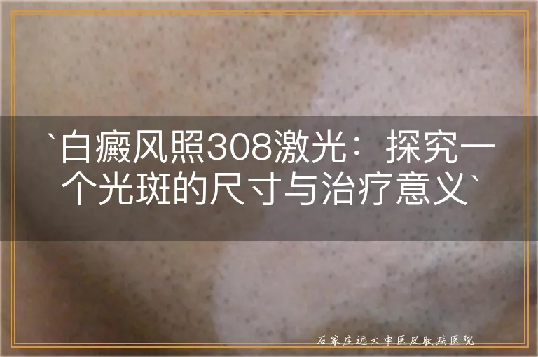 `白癜风照308激光：探究一个光斑的尺寸与治疗意义`