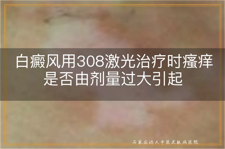 白癜风用308激光治疗时瘙痒是否由剂量过大引起