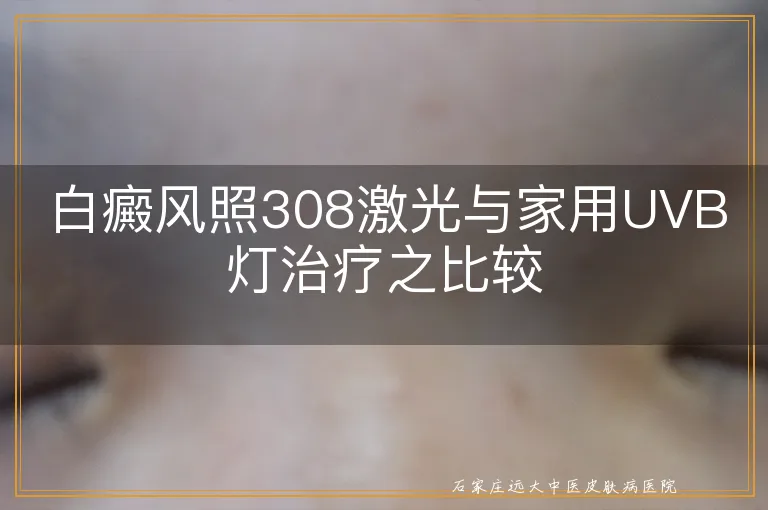 白癜风照308激光与家用UVB灯治疗之比较