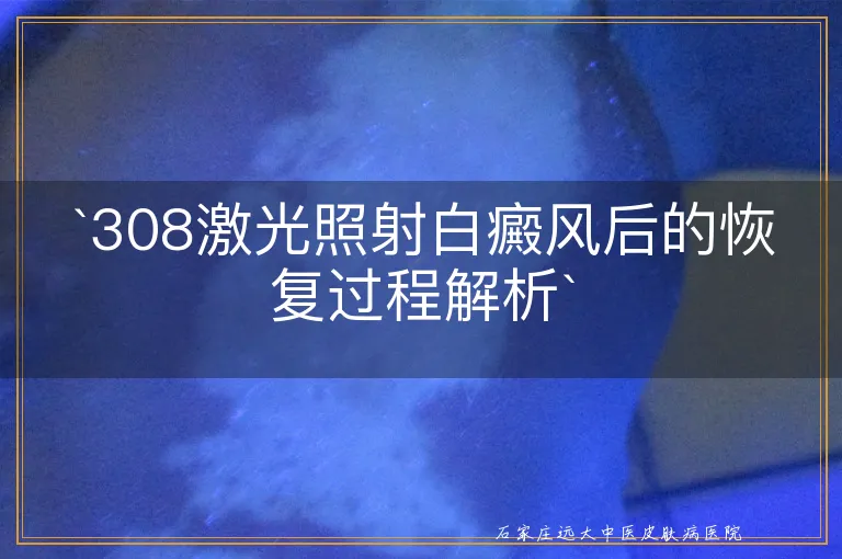 `308激光照射白癜风后的恢复过程解析`