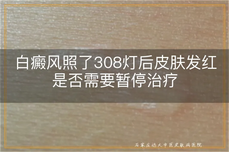 白癜风照了308灯后皮肤发红是否需要暂停治疗