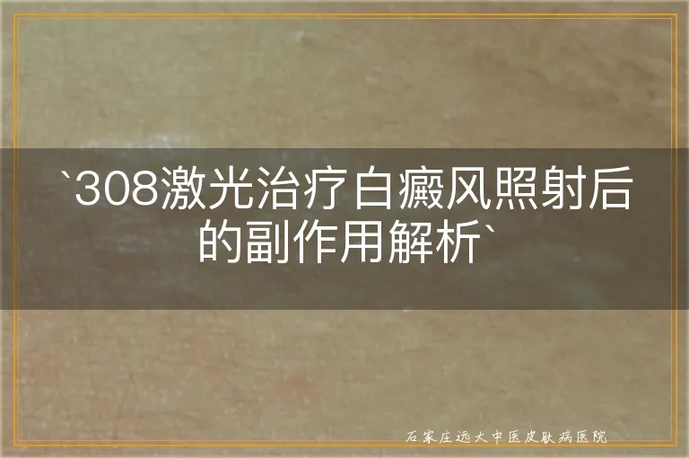 `308激光治疗白癜风照射后的副作用解析`