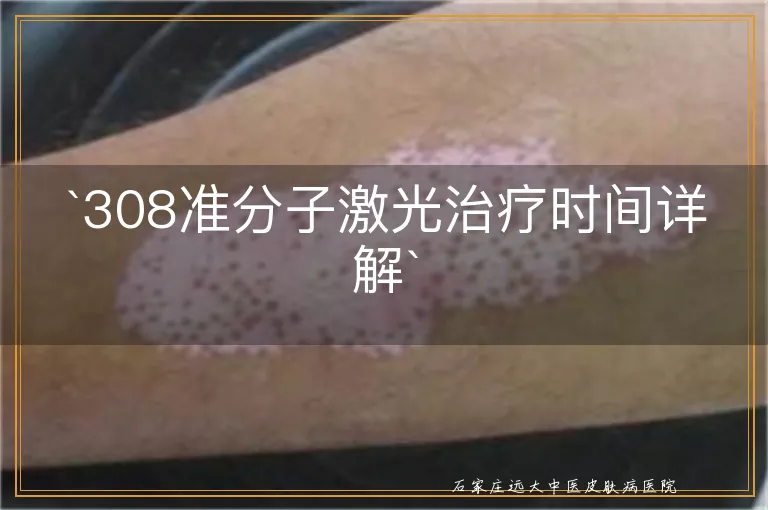 `308准分子激光治疗时间详解`