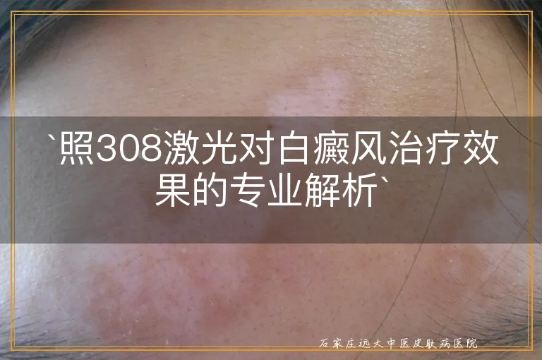 `照308激光对白癜风治疗效果的专业解析`