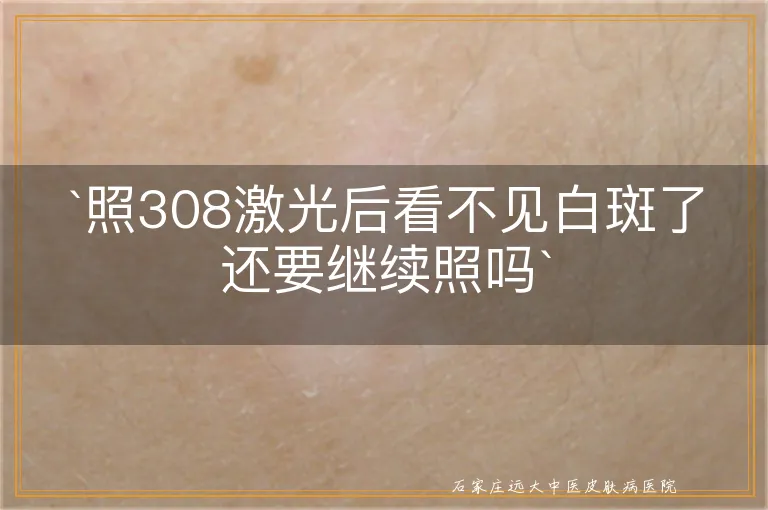 `照308激光后看不见白斑了还要继续照吗`