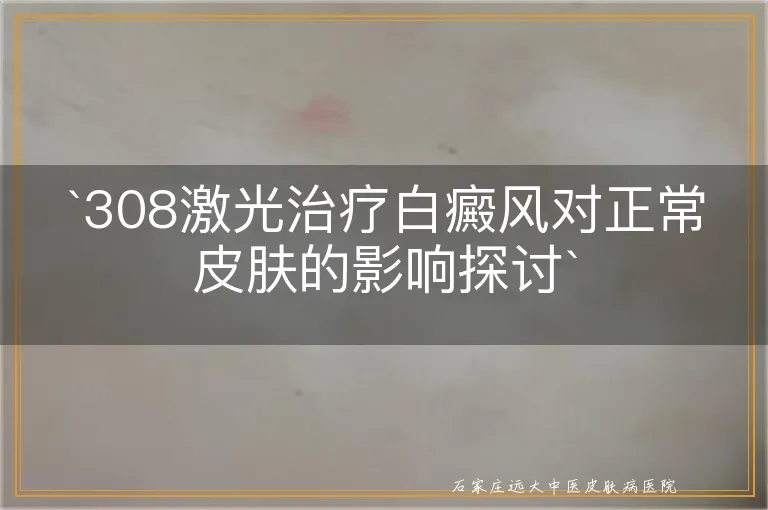 `308激光治疗白癜风对正常皮肤的影响探讨`