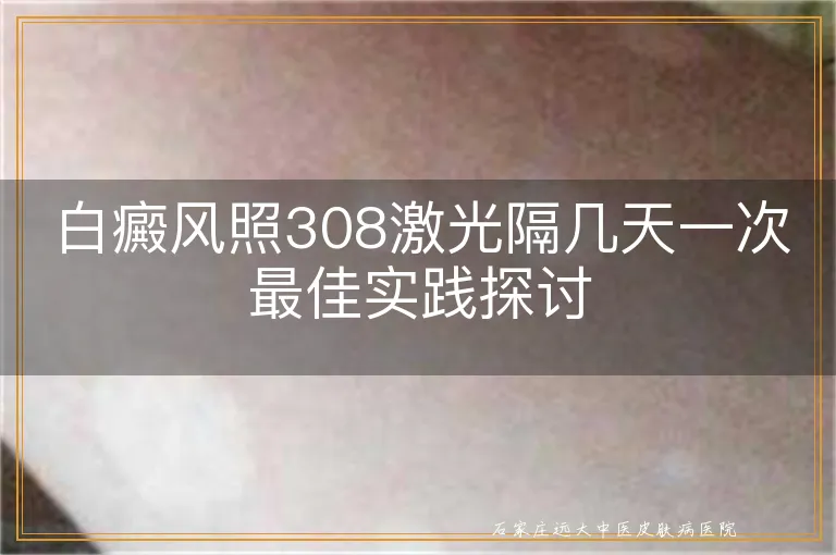 白癜风照308激光隔几天一次最佳实践探讨