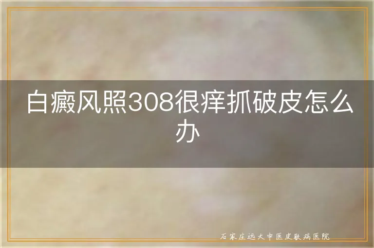 白癜风照308很痒抓破皮怎么办