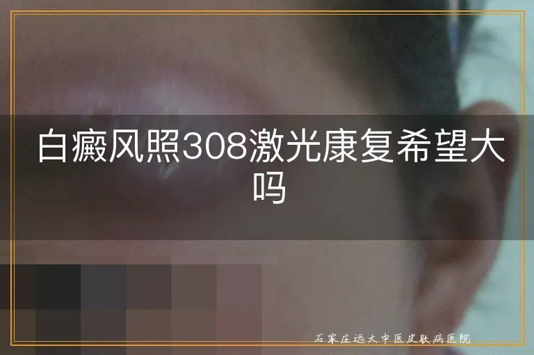 白癜风照308激光康复希望大吗