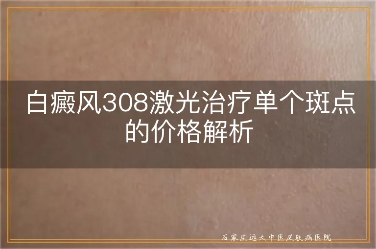 白癜风308激光治疗单个斑点的价格解析