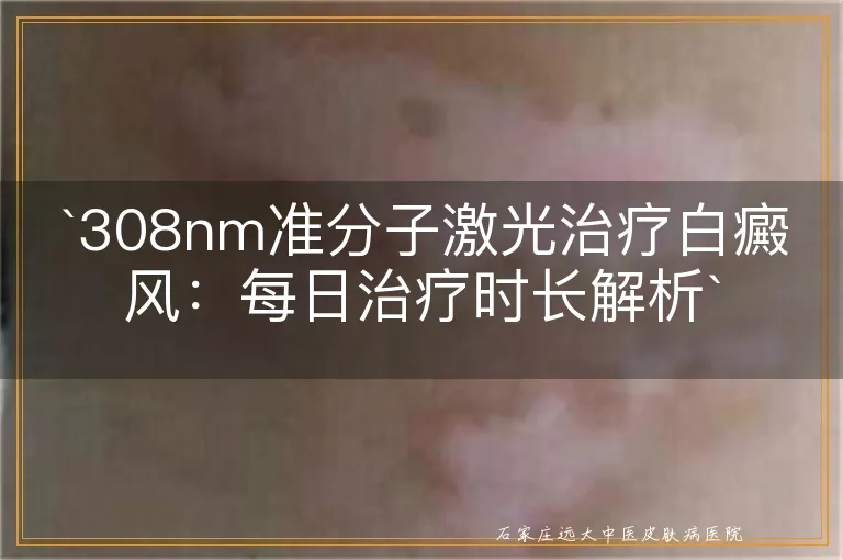 `308nm准分子激光治疗白癜风：每日治疗时长解析`