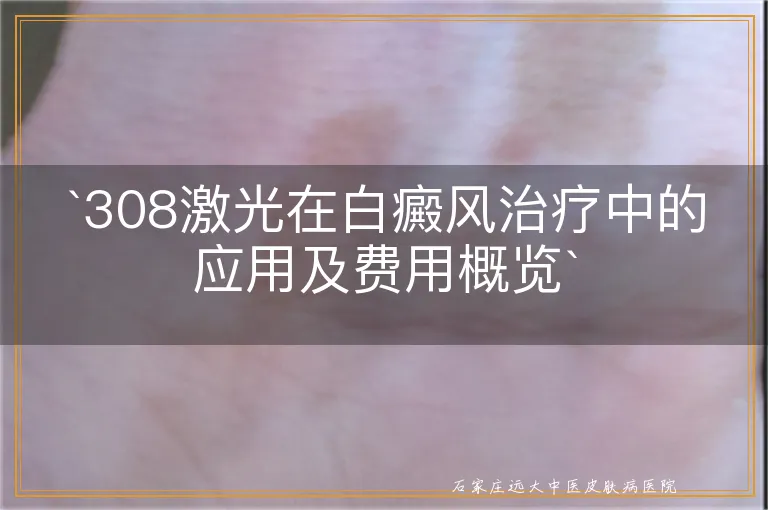 `308激光在白癜风治疗中的应用及费用概览`