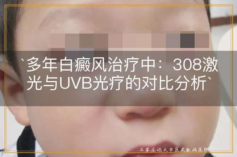 `多年白癜风治疗中：308激光与UVB光疗的对比分析`