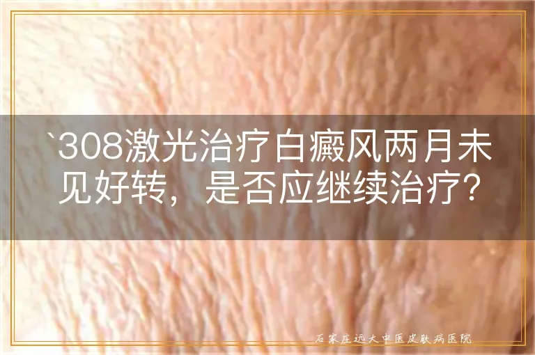 `308激光治疗白癜风两月未见好转，是否应继续治疗？`