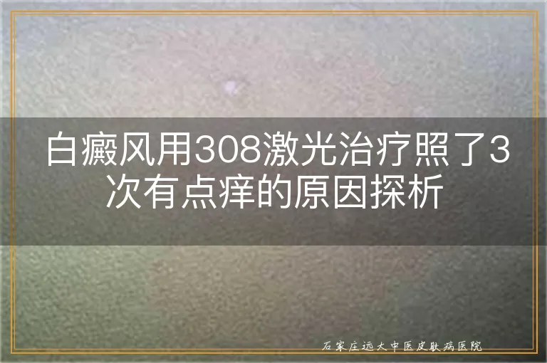 白癜风用308激光治疗照了3次有点痒的原因探析