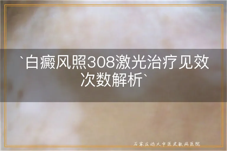 `白癜风照308激光治疗见效次数解析`