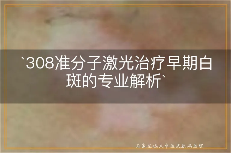 `308准分子激光治疗早期白斑的专业解析`