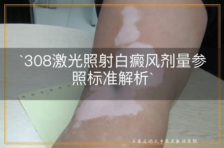 `308激光照射白癜风剂量参照标准解析`