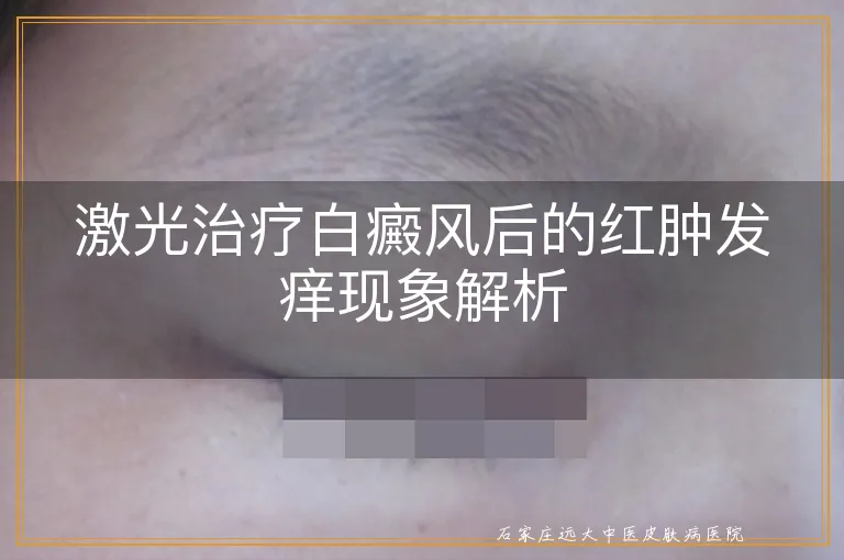 激光治疗白癜风后的红肿发痒现象解析