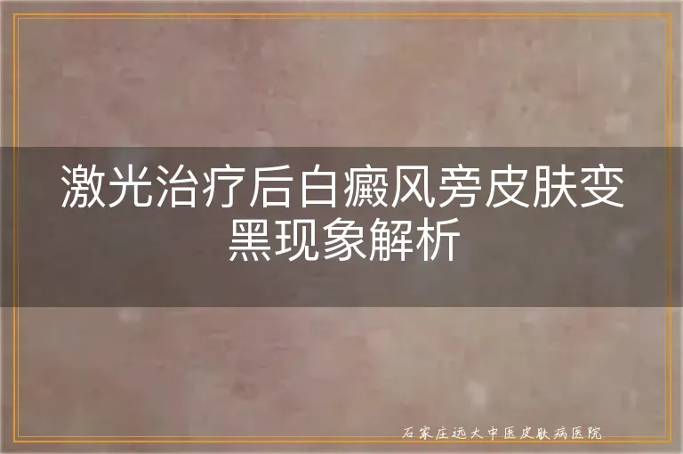 激光治疗后白癜风旁皮肤变黑现象解析