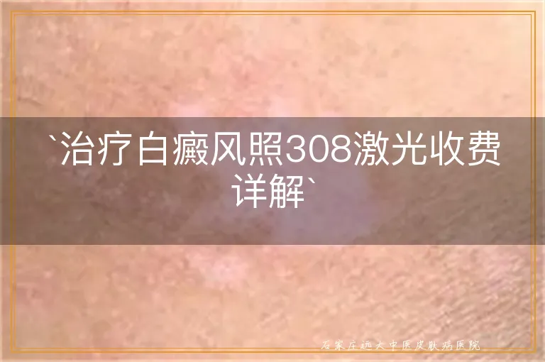 `治疗白癜风照308激光收费详解`