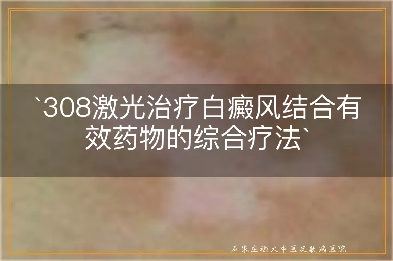 `308激光治疗白癜风结合有效药物的综合疗法`