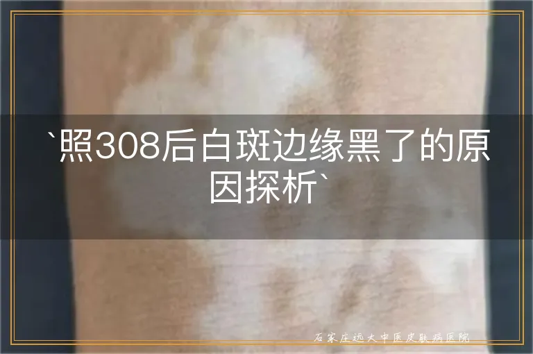 `照308后白斑边缘黑了的原因探析`