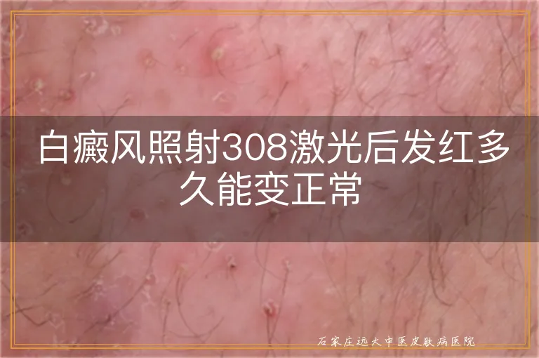 白癜风照射308激光后发红多久能变正常