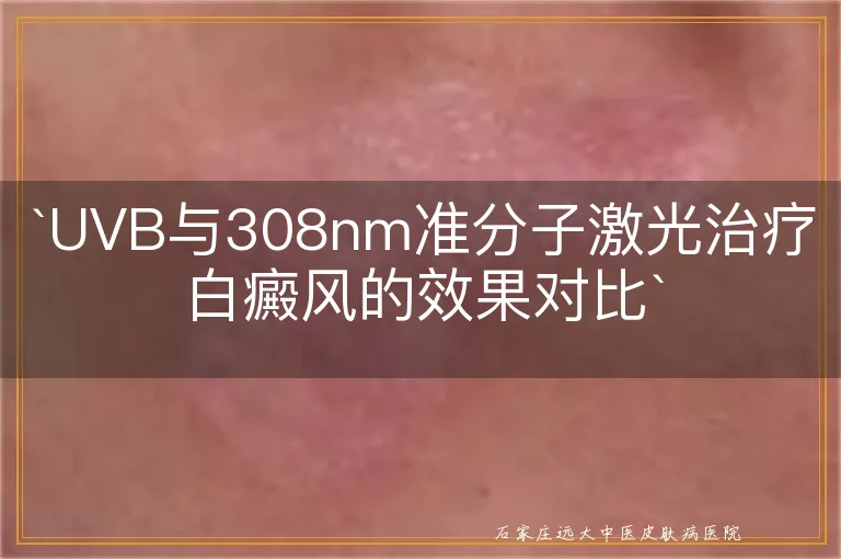 `UVB与308nm准分子激光治疗白癜风的效果对比`