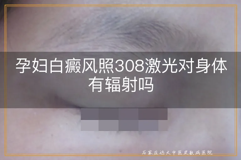 孕妇白癜风照308激光对身体有辐射吗