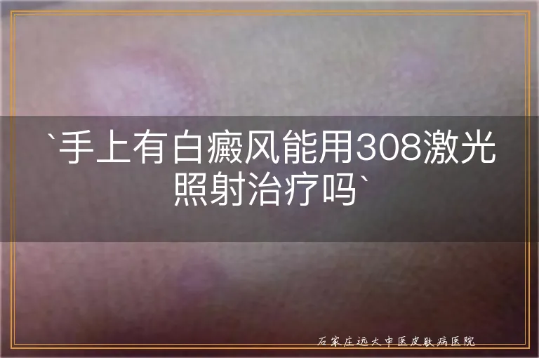 `手上有白癜风能用308激光照射治疗吗`