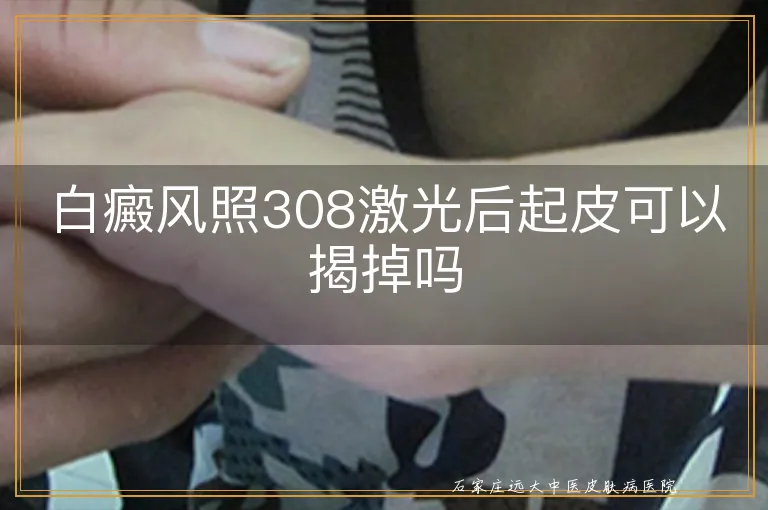 白癜风照308激光后起皮可以揭掉吗