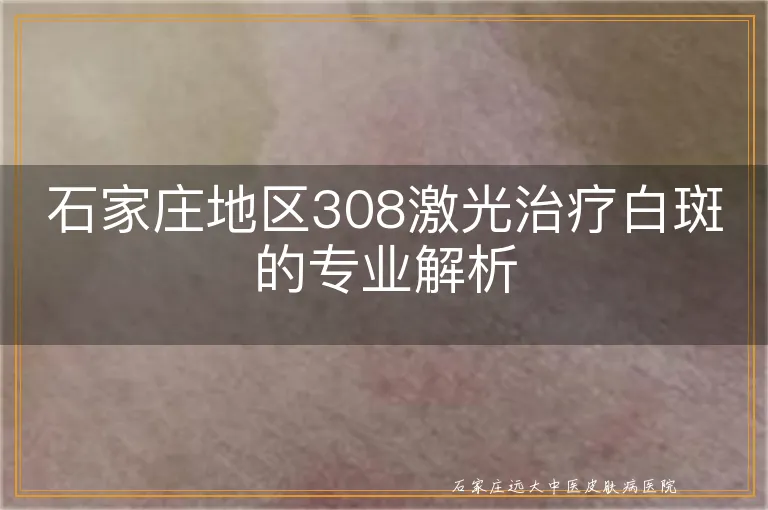 石家庄地区308激光治疗白斑的专业解析