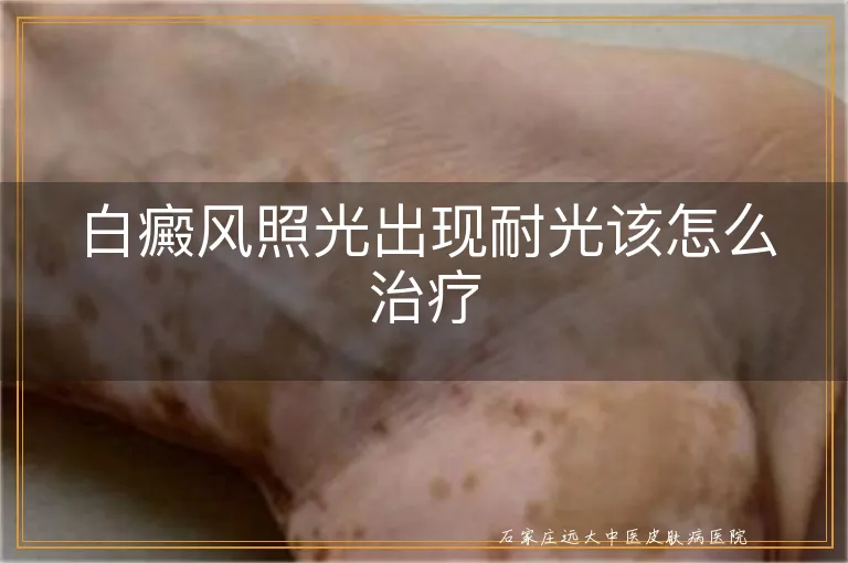 白癜风照光出现耐光该怎么治疗