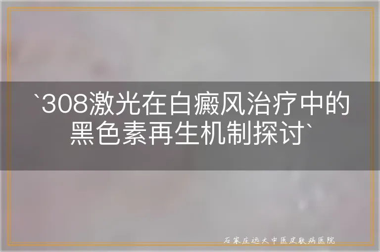 `308激光在白癜风治疗中的黑色素再生机制探讨`