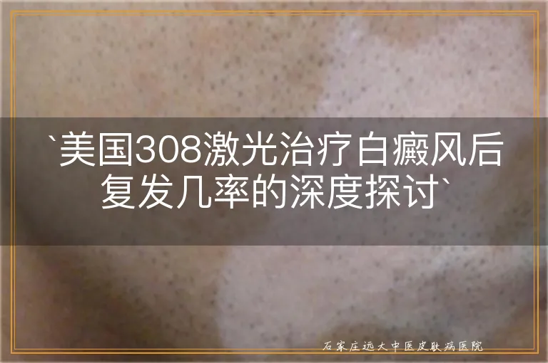 `美国308激光治疗白癜风后复发几率的深度探讨`