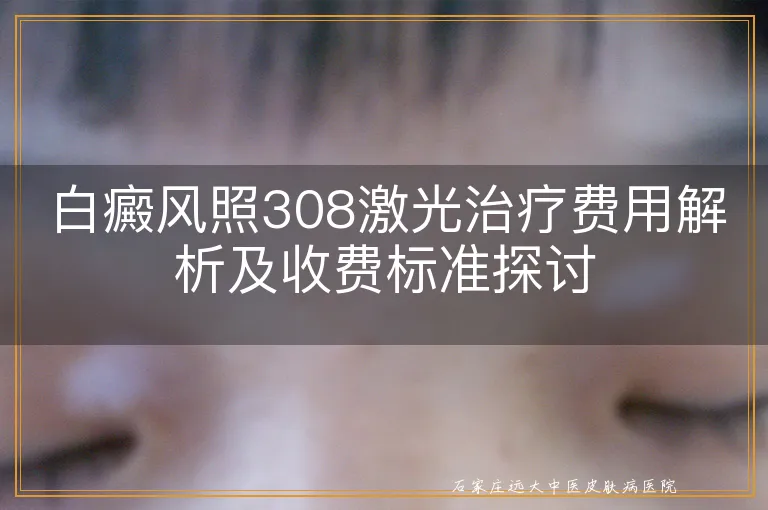 白癜风照308激光治疗费用解析及收费标准探讨